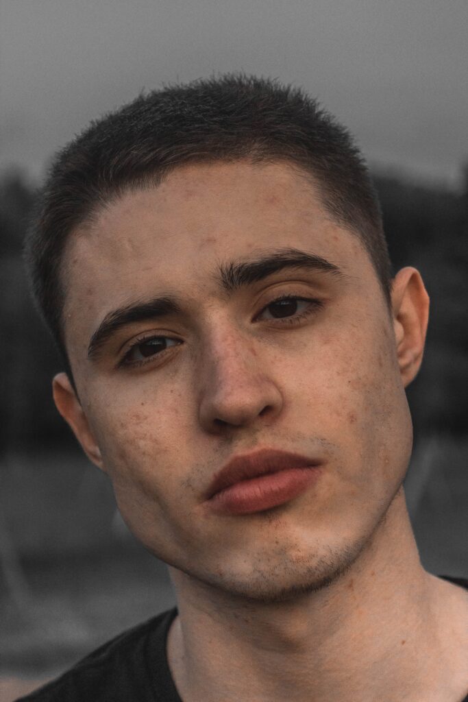 acne sintomi acne foto