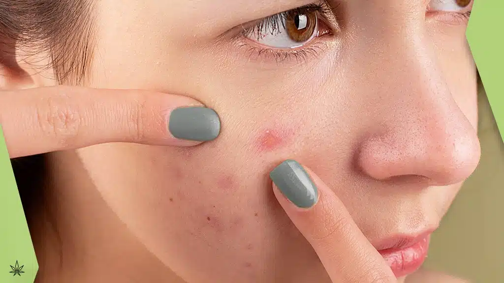 CBD acne