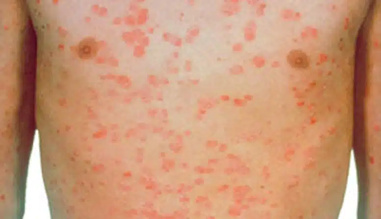 psoriasi foto psoriasi foto