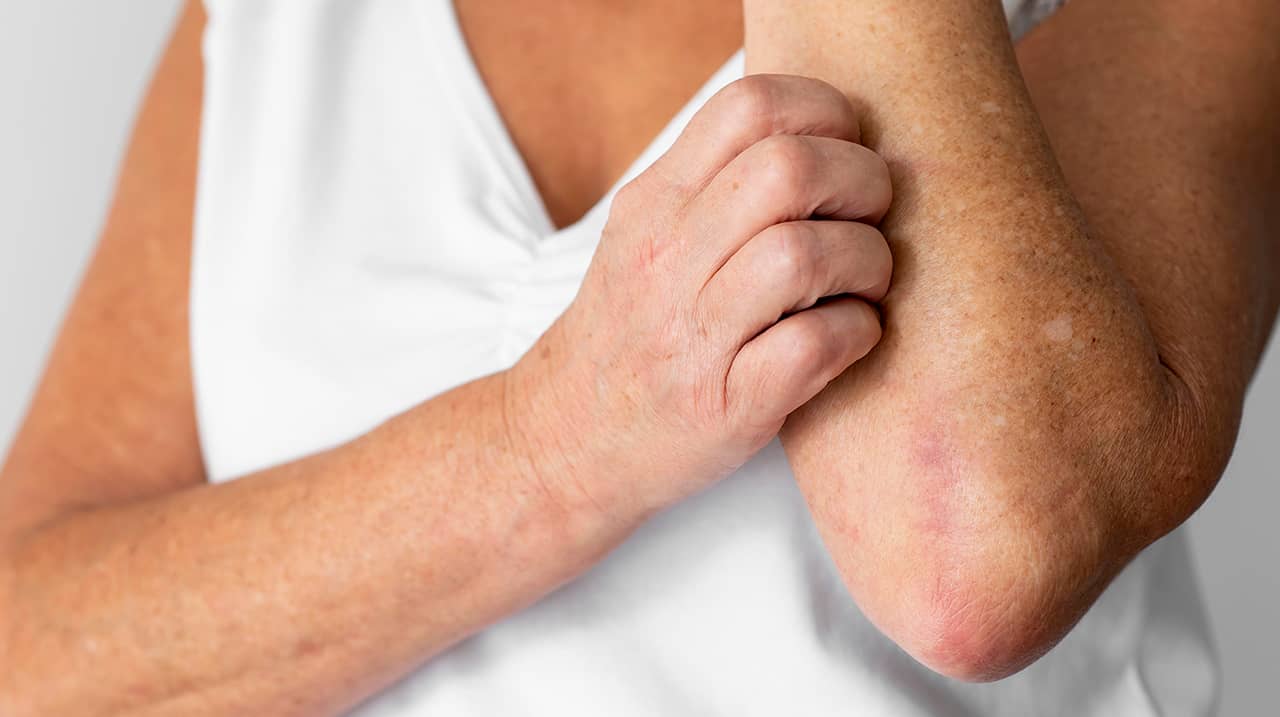 Come curare la dermatite atopica in modo naturale