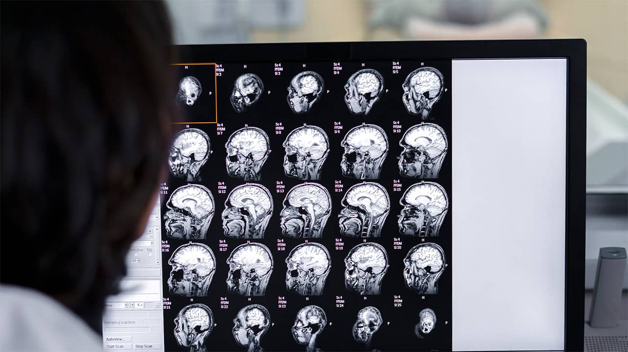 il CBD può provocare Ictus