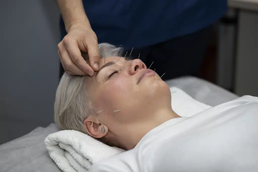 trattamento di agopuntura donna ad alto angolo Trattamento di agopuntura sulla faccia di una persona sdraiata, con il terapeuta che inserisce sottili aghi in un ambiente rilassante.